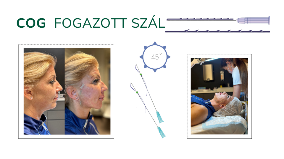 cog fogazott szál