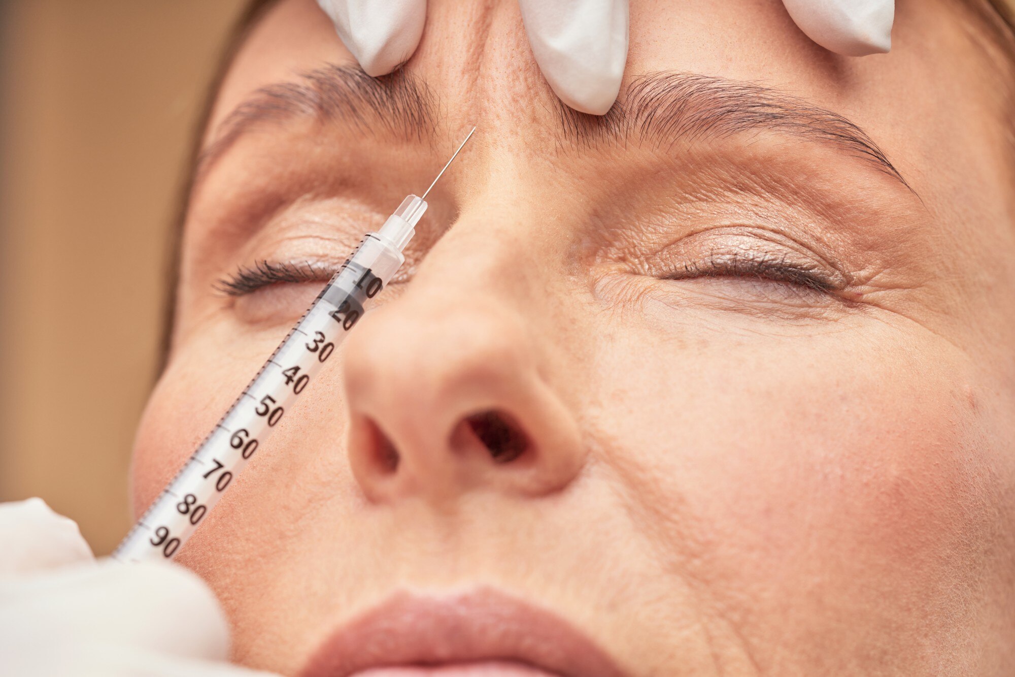 Glabella botox a homlokredők eltüntetésére.